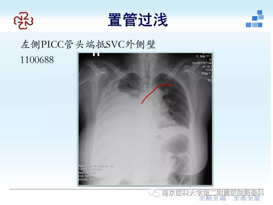 影像PPT - 【PPT】PICC管尖端胸片定位-7