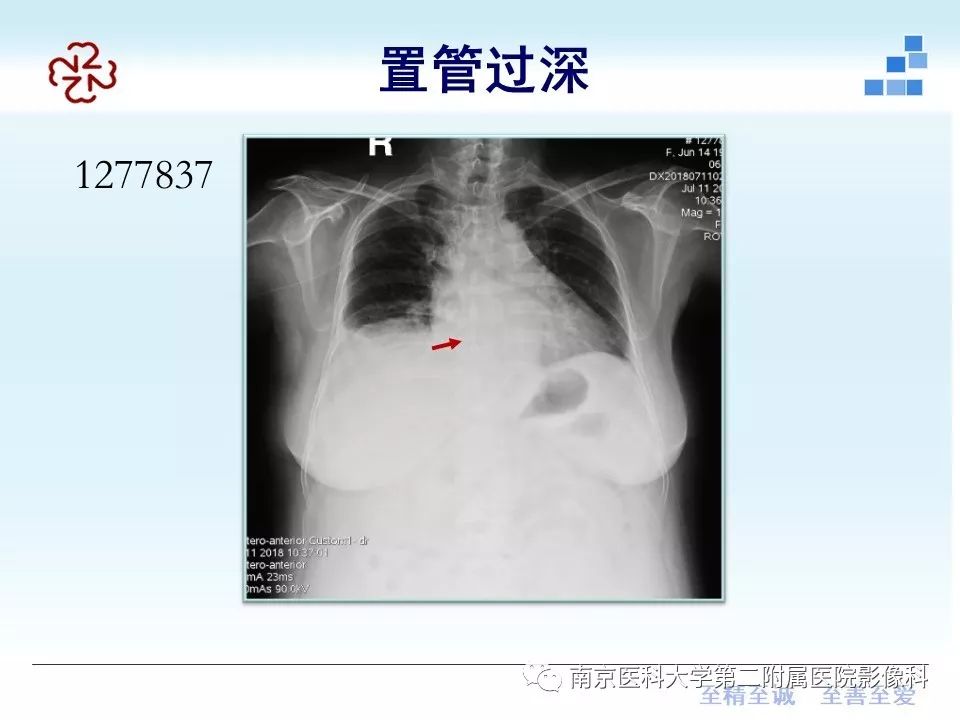 影像PPT - 【PPT】PICC管尖端胸片定位-9