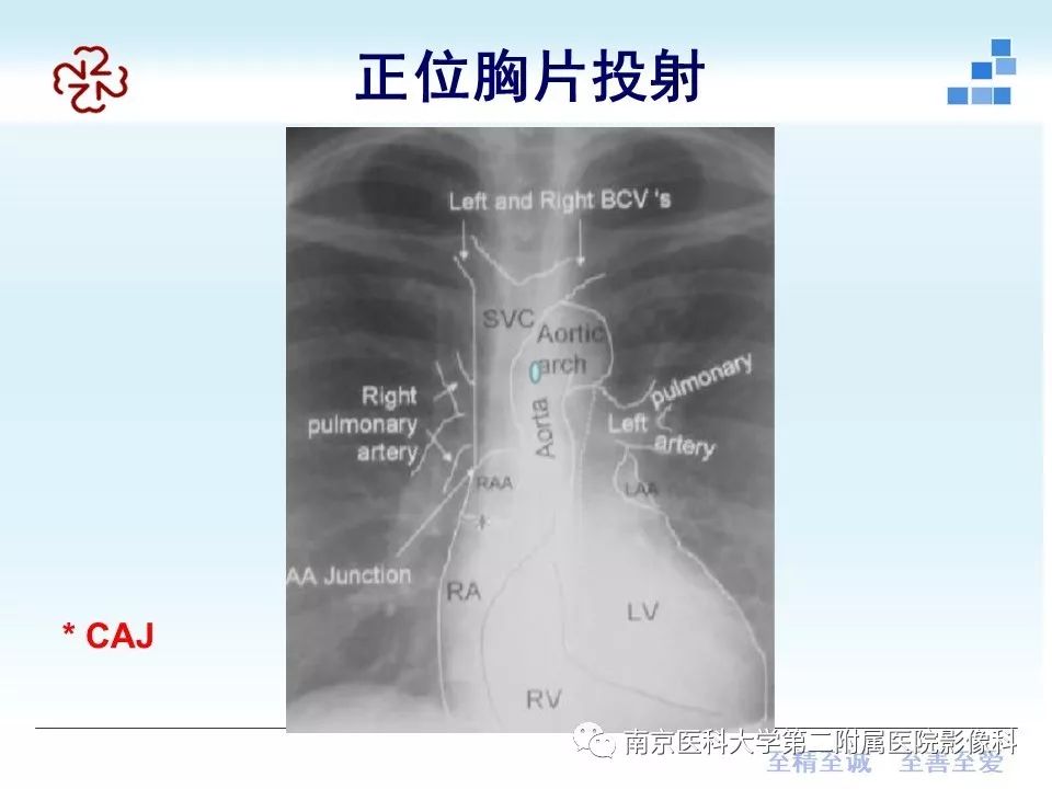 影像PPT - 【PPT】PICC管尖端胸片定位-11