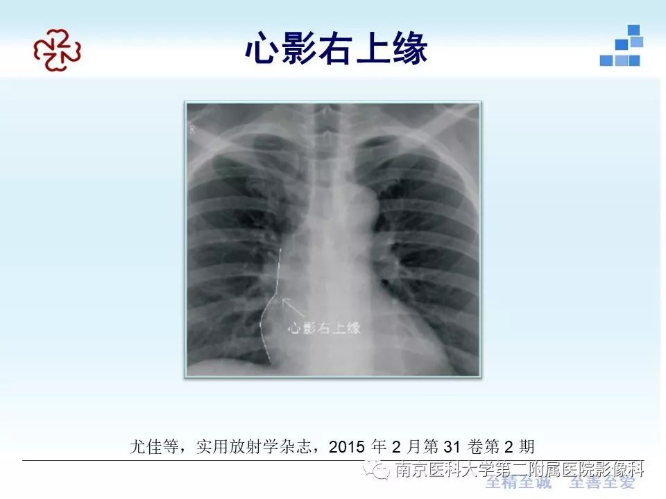 影像PPT - 【PPT】PICC管尖端胸片定位-17