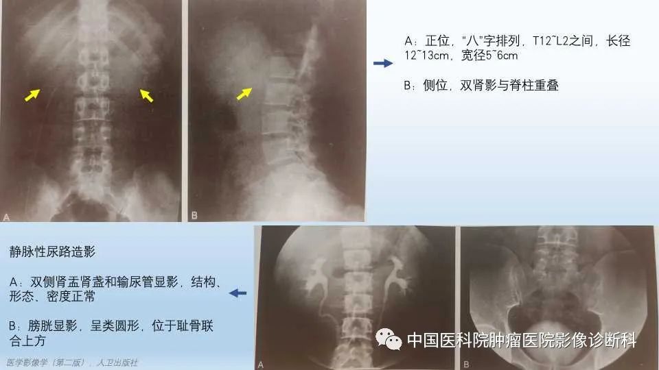 影像PPT - 【PPT】肾囊肿-5