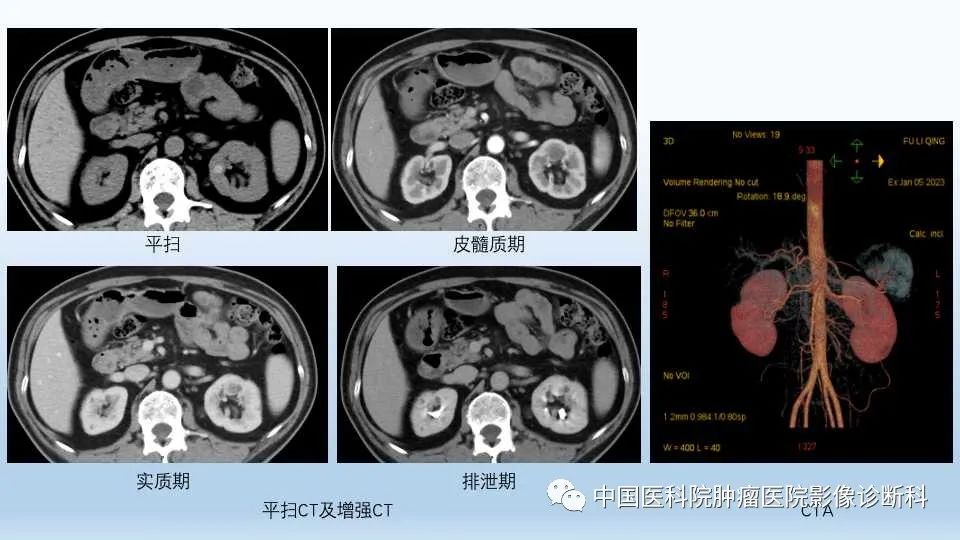 影像PPT - 【PPT】肾囊肿-8