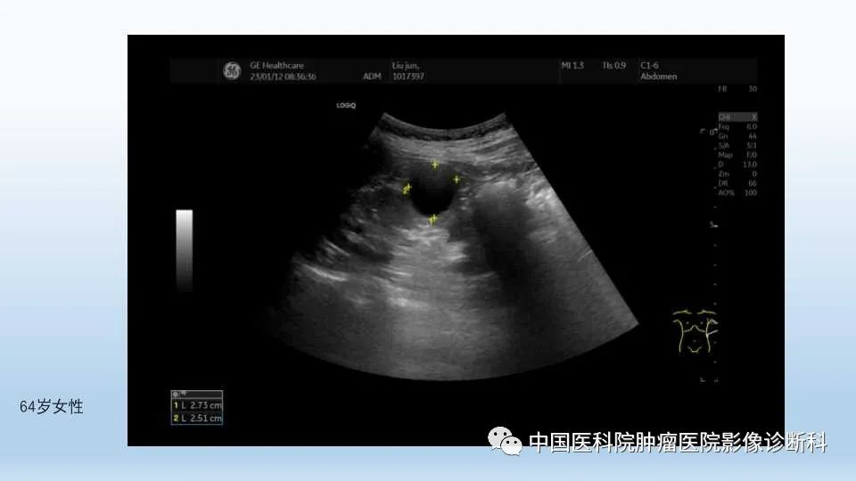 影像PPT - 【PPT】肾囊肿-12