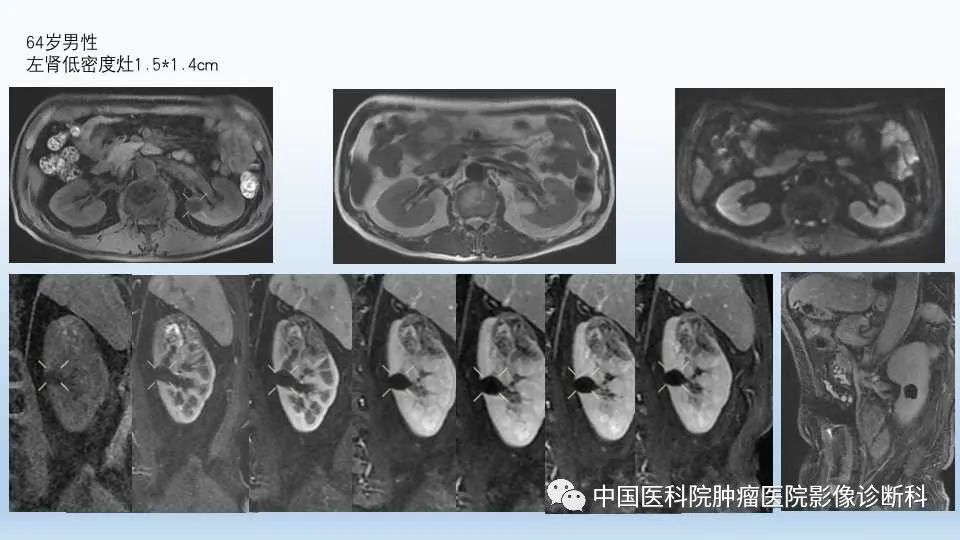 影像PPT - 【PPT】肾囊肿-14