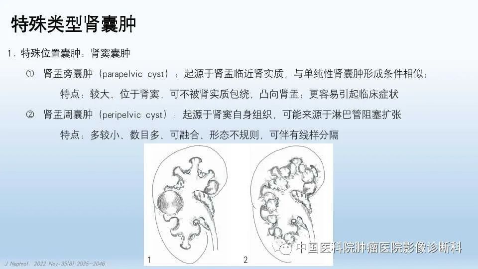 影像PPT - 【PPT】肾囊肿-15