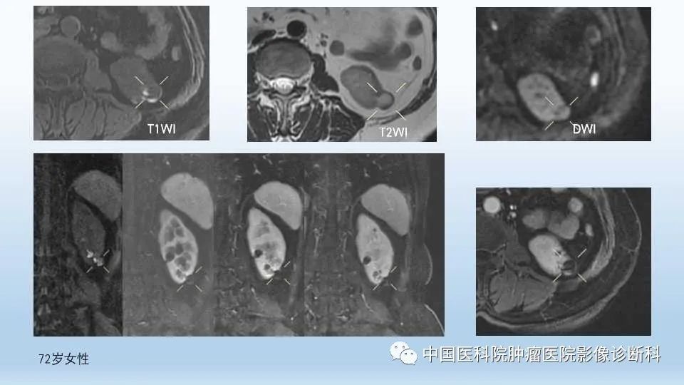 影像PPT - 【PPT】肾囊肿-18
