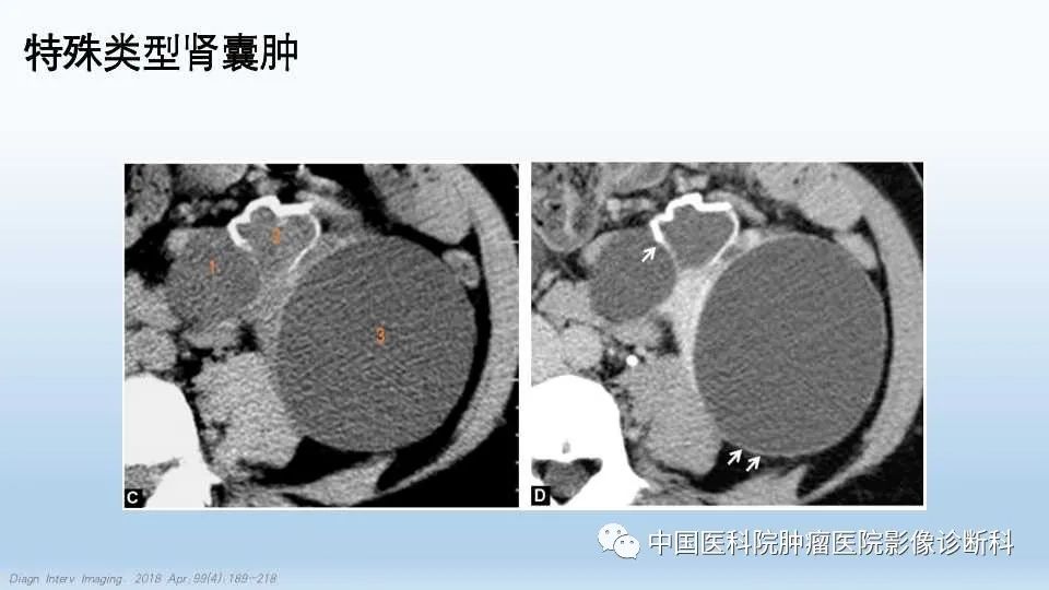 影像PPT - 【PPT】肾囊肿-17