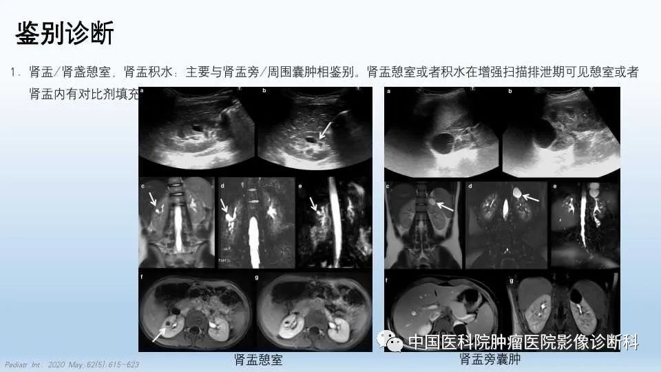 影像PPT - 【PPT】肾囊肿-20