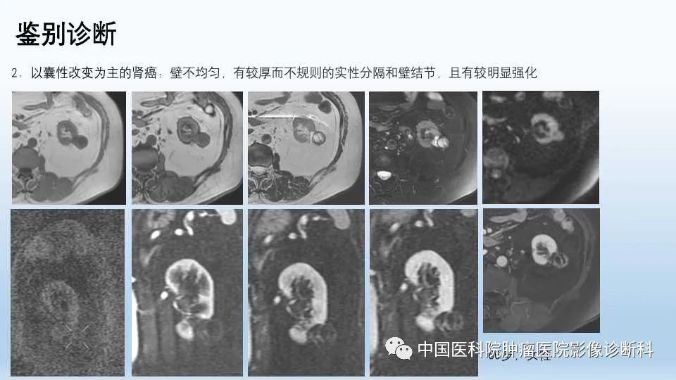 影像PPT - 【PPT】肾囊肿-21
