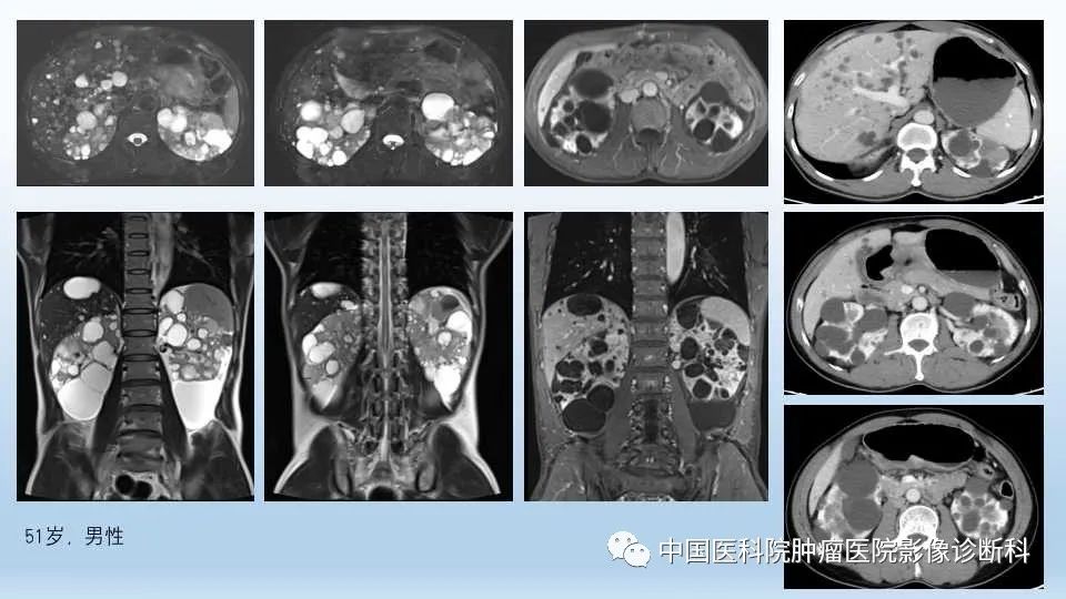 影像PPT - 【PPT】肾囊肿-23