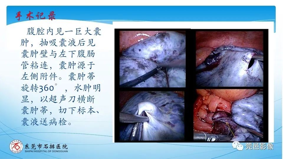 影像PPT - 【PPT】一例卵巢肿瘤蒂扭转病例分享-11