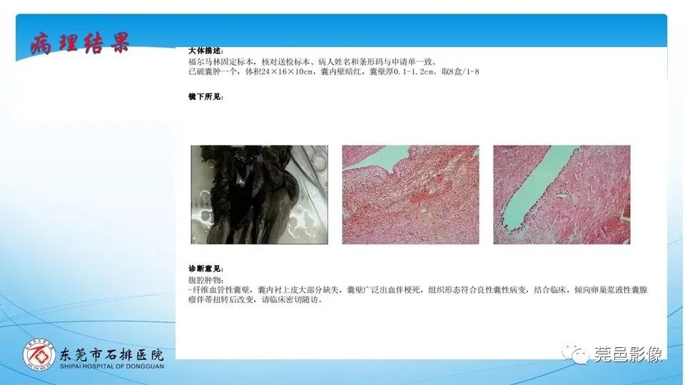 影像PPT - 【PPT】一例卵巢肿瘤蒂扭转病例分享-12