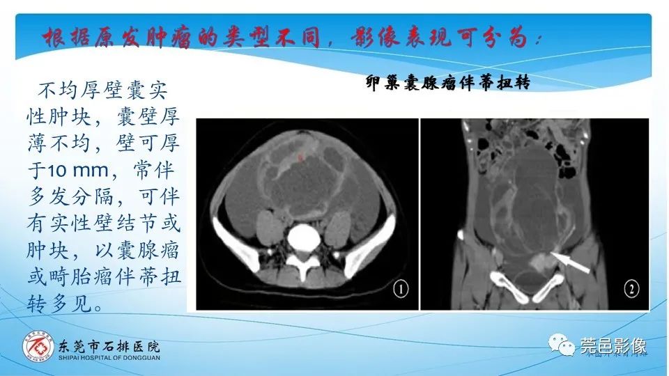 影像PPT - 【PPT】一例卵巢肿瘤蒂扭转病例分享-15
