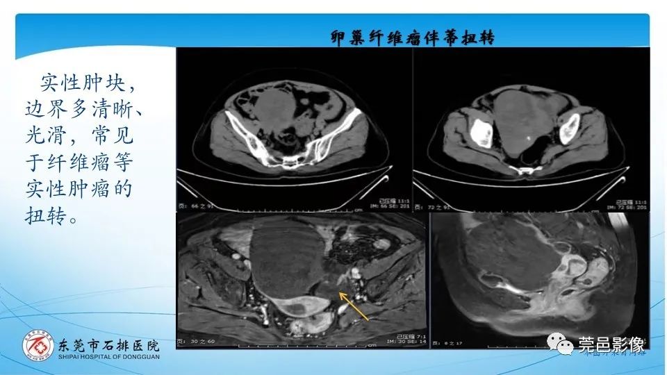 影像PPT - 【PPT】一例卵巢肿瘤蒂扭转病例分享-17