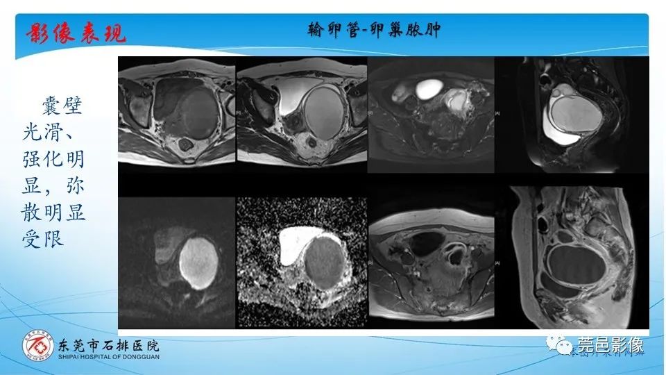 影像PPT - 【PPT】一例卵巢肿瘤蒂扭转病例分享-22