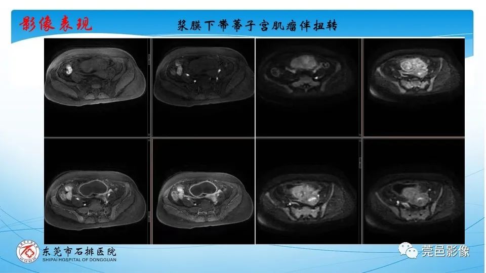 影像PPT - 【PPT】一例卵巢肿瘤蒂扭转病例分享-26