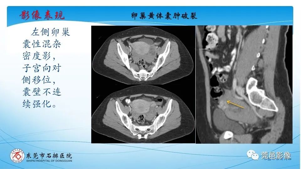 影像PPT - 【PPT】一例卵巢肿瘤蒂扭转病例分享-24