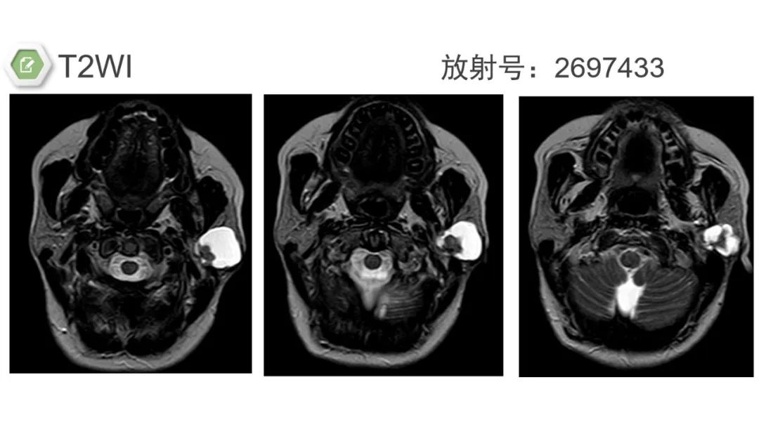 影像PPT - 【病例】腮腺肌上皮瘤1例MR影像-3 影像PPT - 【病例】腮腺肌上皮瘤1例MR影像-3