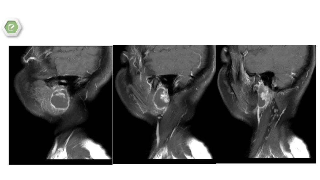 影像PPT - 【病例】腮腺肌上皮瘤1例MR影像-8 影像PPT - 【病例】腮腺肌上皮瘤1例MR影像-8