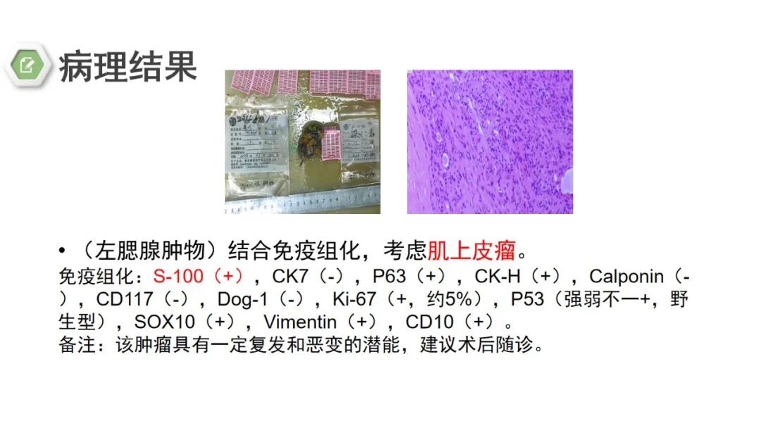 影像PPT - 【病例】腮腺肌上皮瘤1例MR影像-13 影像PPT - 【病例】腮腺肌上皮瘤1例MR影像-13