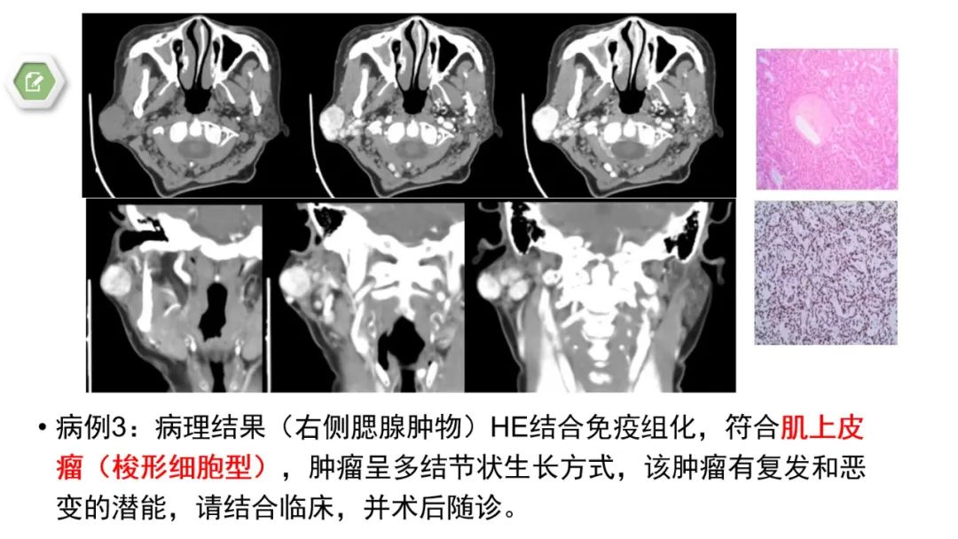 影像PPT - 【病例】腮腺肌上皮瘤1例MR影像-19 影像PPT - 【病例】腮腺肌上皮瘤1例MR影像-19