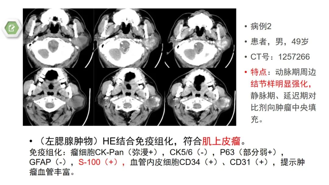 影像PPT - 【病例】腮腺肌上皮瘤1例MR影像-18 影像PPT - 【病例】腮腺肌上皮瘤1例MR影像-18