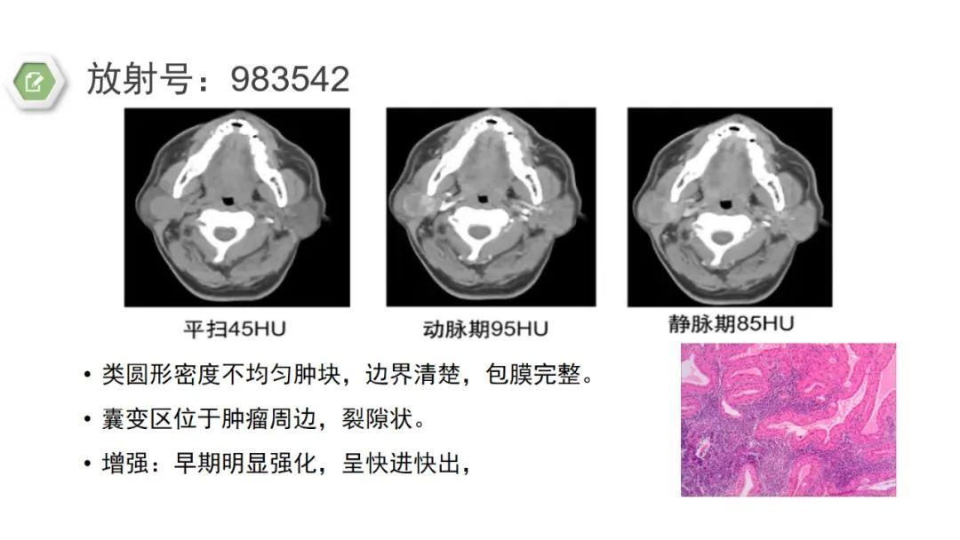 影像PPT - 【病例】腮腺肌上皮瘤1例MR影像-21 影像PPT - 【病例】腮腺肌上皮瘤1例MR影像-21