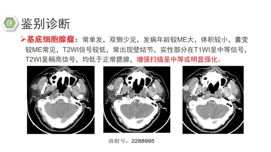 影像PPT - 【病例】腮腺肌上皮瘤1例MR影像-22 影像PPT - 【病例】腮腺肌上皮瘤1例MR影像-22