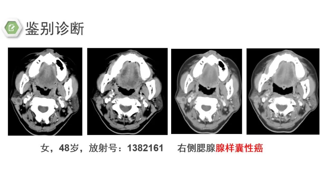 影像PPT - 【病例】腮腺肌上皮瘤1例MR影像-24 影像PPT - 【病例】腮腺肌上皮瘤1例MR影像-24