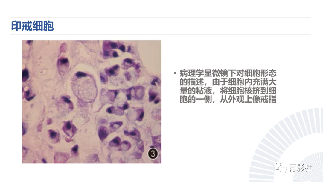 影像PPT - 【PPT】阑尾粘液性肿瘤的诊断-7