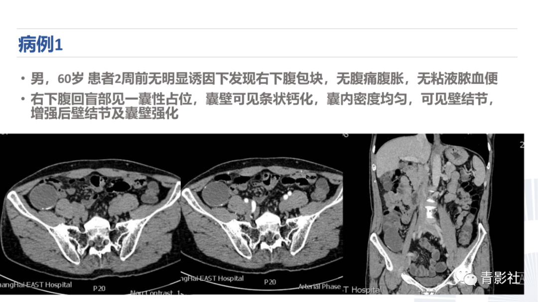 影像PPT - 【PPT】阑尾粘液性肿瘤的诊断-12