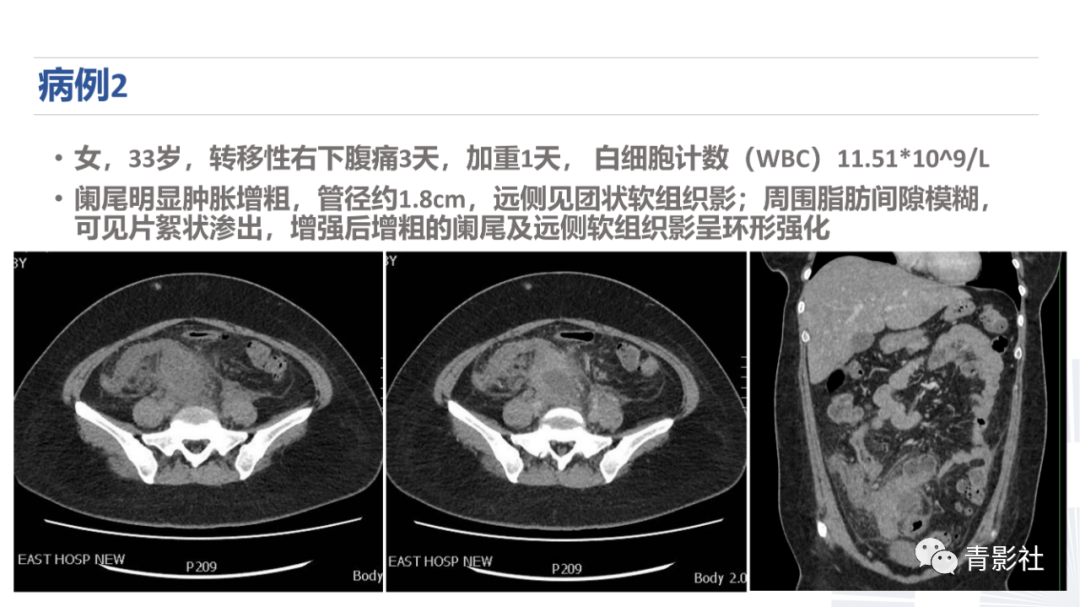 影像PPT - 【PPT】阑尾粘液性肿瘤的诊断-16