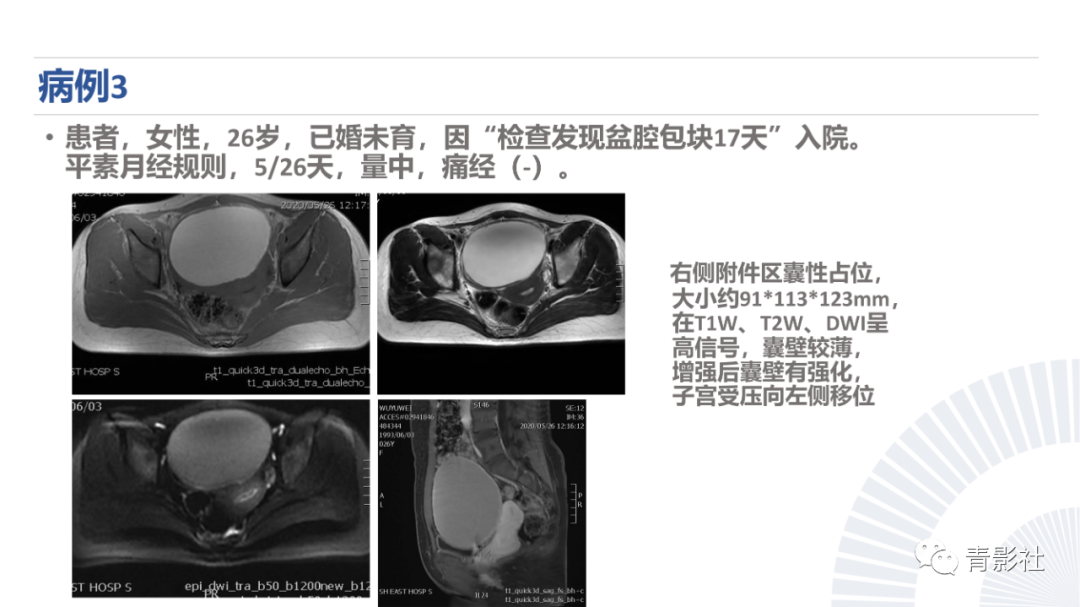 影像PPT - 【PPT】阑尾粘液性肿瘤的诊断-19