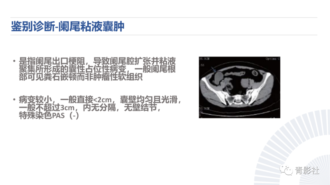 影像PPT - 【PPT】阑尾粘液性肿瘤的诊断-21
