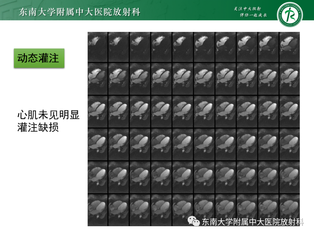 影像PPT - 【PPT】心脏结节病MR表现-4