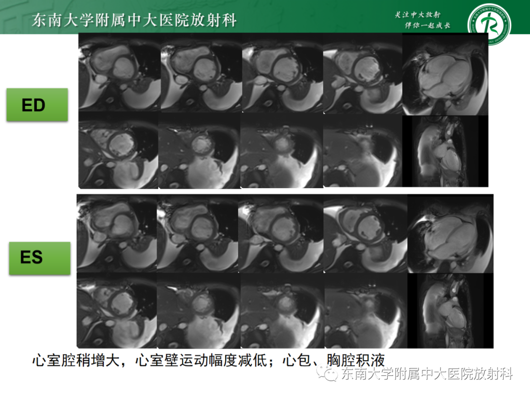 影像PPT - 【PPT】心脏结节病MR表现-2
