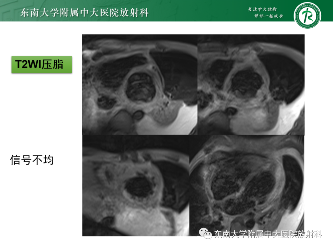 影像PPT - 【PPT】心脏结节病MR表现-5