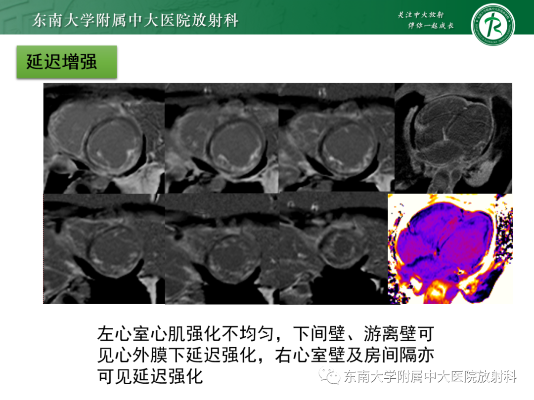 影像PPT - 【PPT】心脏结节病MR表现-6