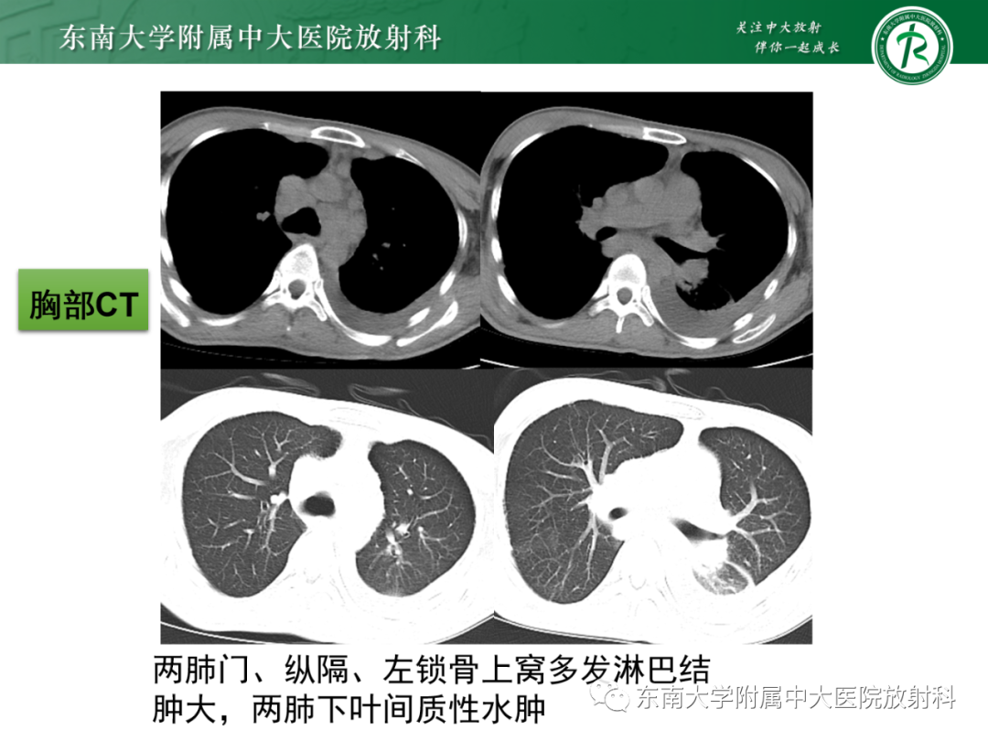 影像PPT - 【PPT】心脏结节病MR表现-7