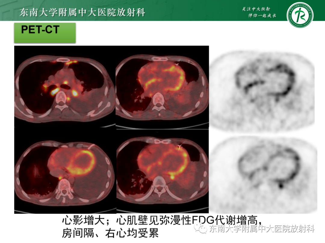 影像PPT - 【PPT】心脏结节病MR表现-8