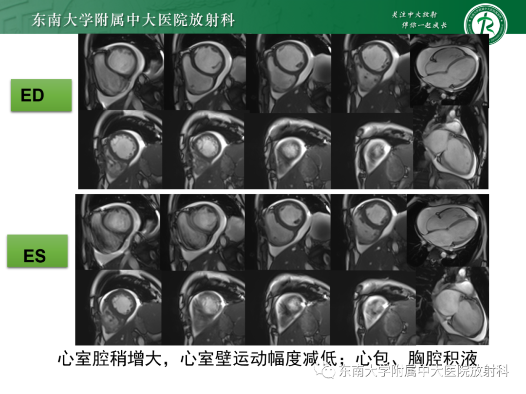 影像PPT - 【PPT】心脏结节病MR表现-12