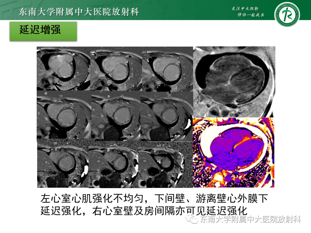 影像PPT - 【PPT】心脏结节病MR表现-15