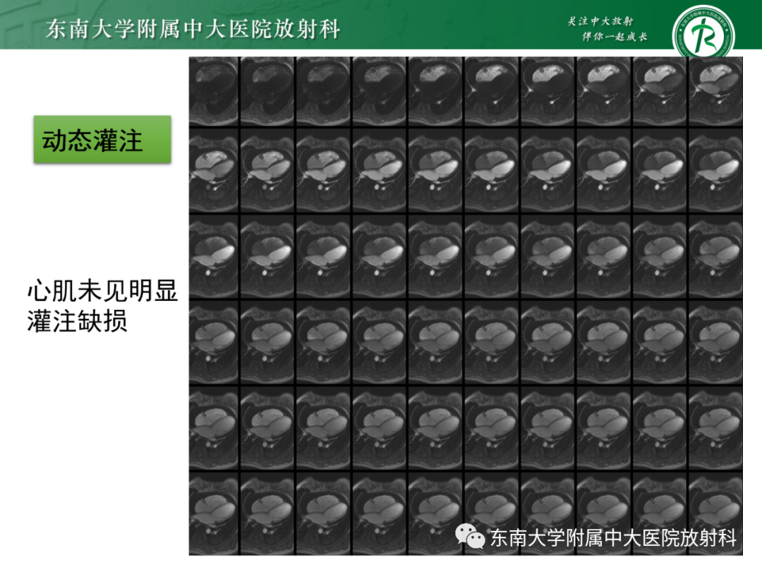 影像PPT - 【PPT】心脏结节病MR表现-14