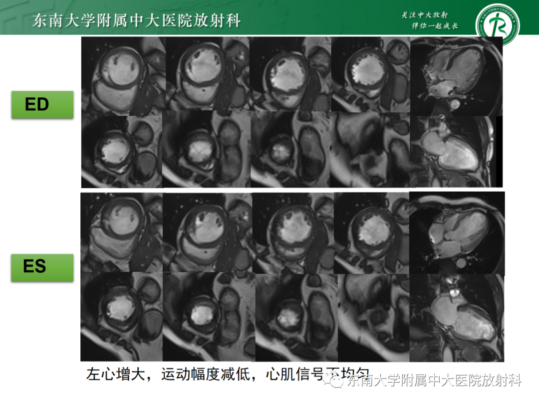 影像PPT - 【PPT】心脏结节病MR表现-19