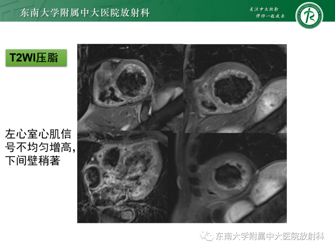 影像PPT - 【PPT】心脏结节病MR表现-21