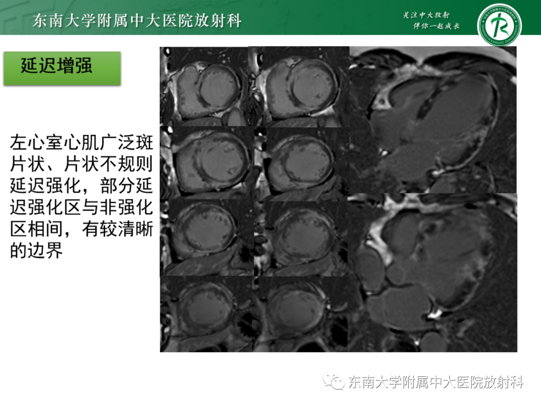 影像PPT - 【PPT】心脏结节病MR表现-22