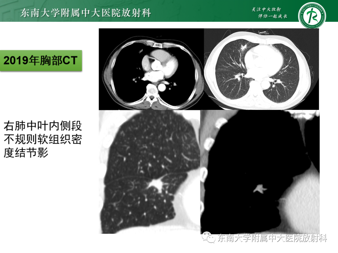 影像PPT - 【PPT】心脏结节病MR表现-24