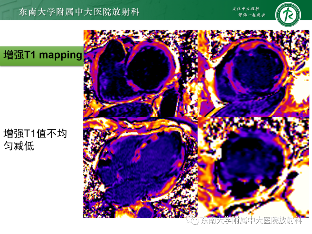 影像PPT - 【PPT】心脏结节病MR表现-23