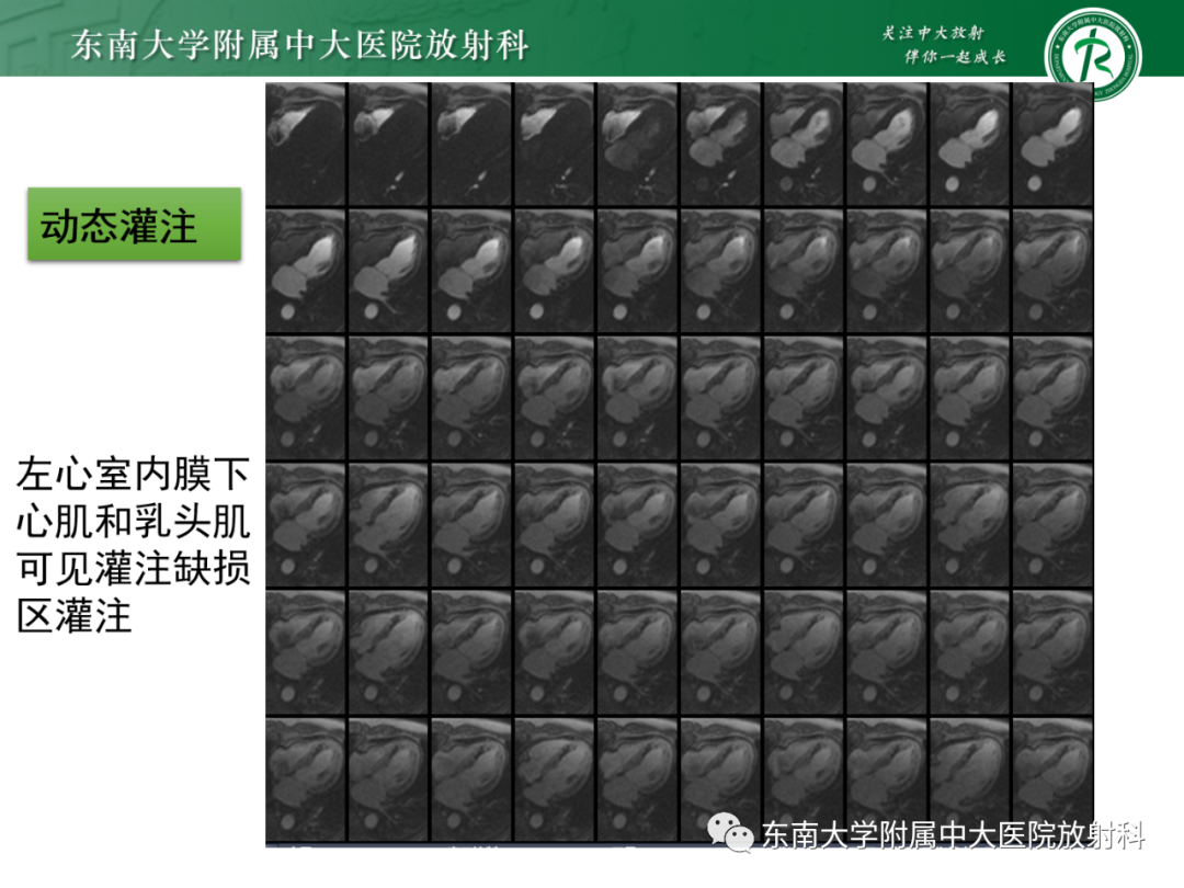 影像PPT - 【PPT】心脏结节病MR表现-33