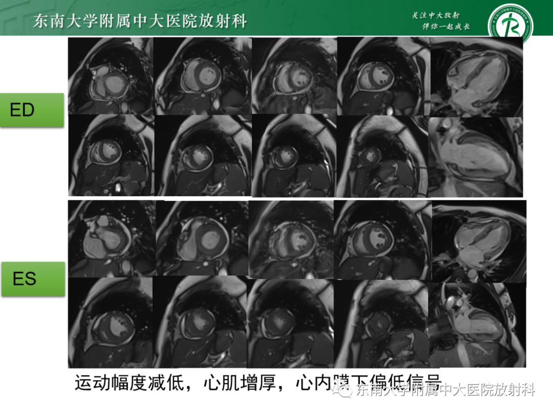 影像PPT - 【PPT】心脏结节病MR表现-31